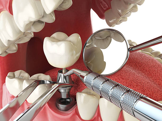 Best Emergency Tooth Extraction in Terry, MS